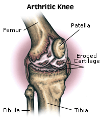 arthritic_knee