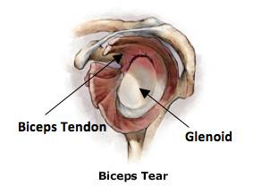 Bicep Tear At Shoulder Treatment